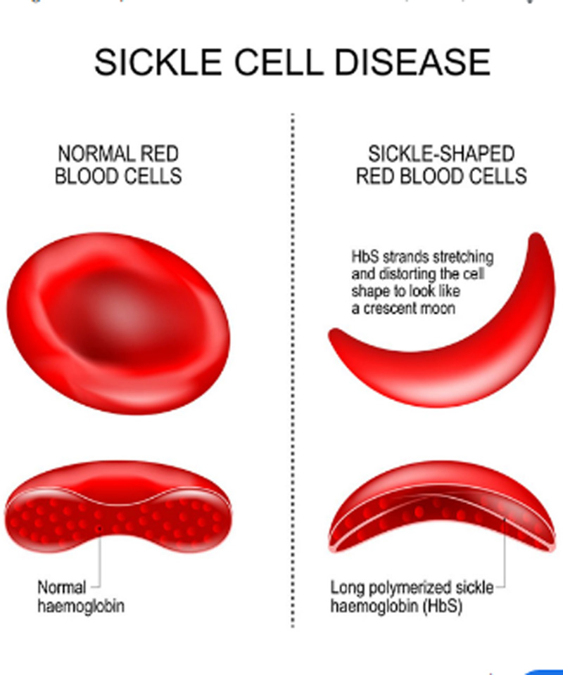 सिकलसेल तपासणी करा व सिकल आजाराची साखळी खंडीत करा – NNL
