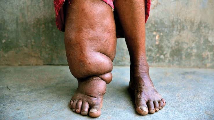Elephantiasis patient : नांदेड जिल्ह्यात हत्तीरोग रुग्ण शोध मोहीम सुरुवात, जिल्हा आरोग्य अधिकारी यांची हत्तीरोग रूग्णास भेट